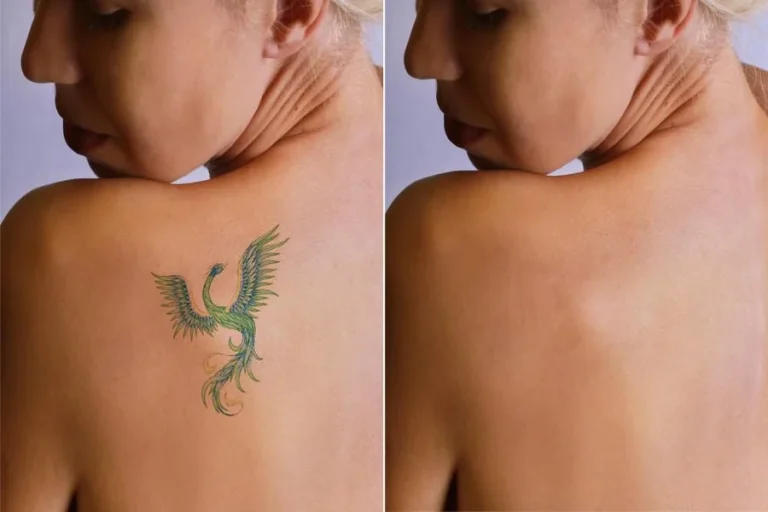 7 Questions to Ask If Tattoo Removal Is Right for You